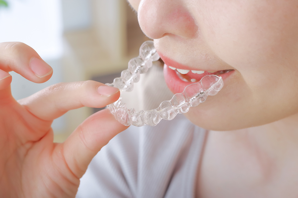 インビザライン矯正