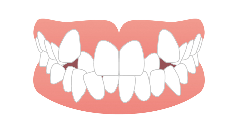 乱ぐい歯（叢生）