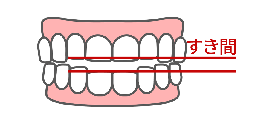 上下の歯列間のすき間