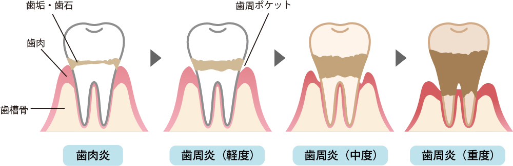 歯周病進行